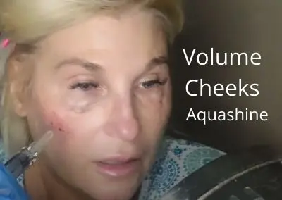 AQUASHINE | Added Volume to Cheeks | GlamDerma