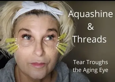 Aquashine and Threads for Tear Troughs the Aging Eye