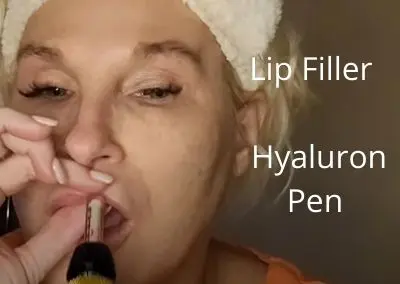 Lip Filler | Tesoro Filler | Hyaluron Pen