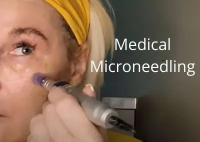 Medical Microneedling