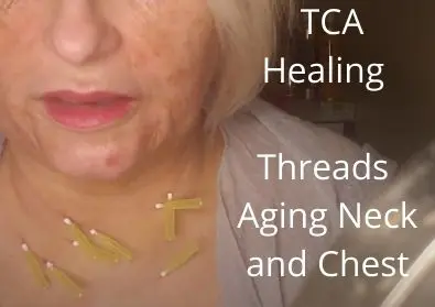 Empowered TCA Healing | Threads 30g 38mm | Aging Neck and Chest