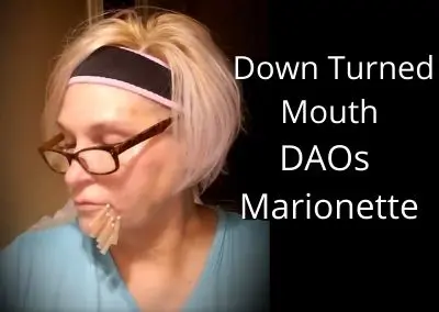 Fix Down Turned Mouth | DAOs | Marionette Lines (this video is 6 months old)