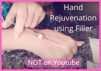 Hand Rejuvenation using Filler (Tesoro) | Video NOT on Youtube