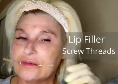 Lip Filler – Screw Threads