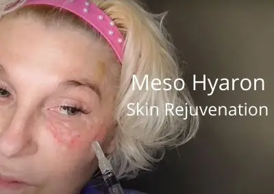 Meso Hyaron | Skin Rejuvenation