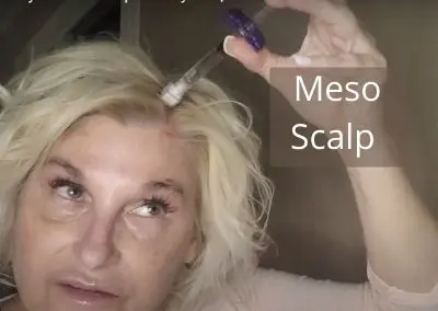 Meso your Hair Scalp with Hyaron, Stem Cells  | Treatments for All Ages and Hair Type