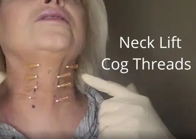 Neck Lift Cog threads | Amazing Results