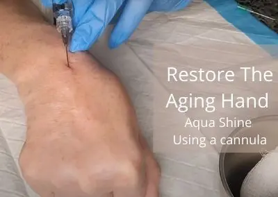 Restore The Aging Hand | Aqua Shine | Using a cannula