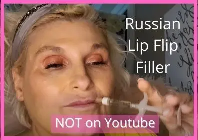 Russian Lip Flip using Filler | Video Not on Youtube