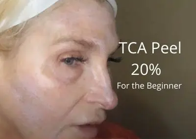 TCA Peel 20% | Details for the Beginner