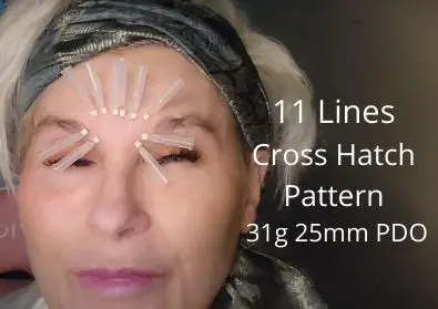 11 Lines | Cross Hatch Thread Pattern | 31g 25mm PDO