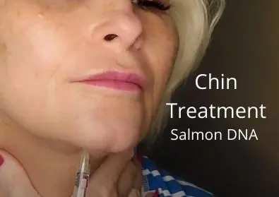 Chin Treatment | Salmon DNA | Huge giveaway