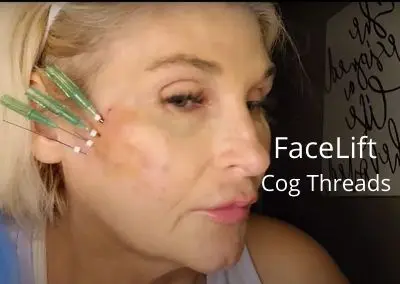 FaceLift with Cog Threads | Nonsurgical FaceLift