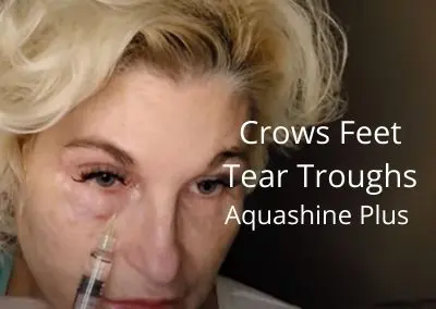 Crows Feet and Tear Troughs – Aquashine Plus Meso