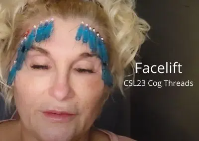 Facelift using CSL23 Cog Threads