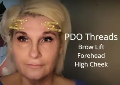 Brow and Cheek Lift with PDO Threads