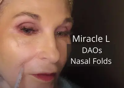 Miracle L – Meso – DAOs and Nasal Folds