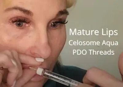 Plumping up Mature Lips for a Natural Look using Celosome Aqua and PDO Threads