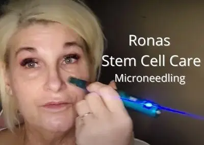 Ronas Stem Cell Care – Microneedle Mature skin