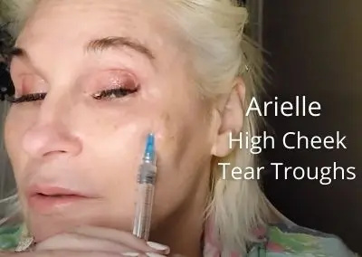 Meso with Arielle – High Cheeks & Tear Troughs