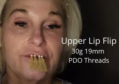 Upper Lip Flip using 30g 19mm PDO Threads