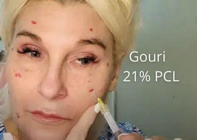 Gouri –  21% PCL