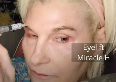 Eyelift using Miracle H PCL