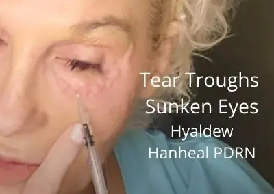 Tear Troughs / Sunken Eyes – Hyaldew Hanheal PDRN