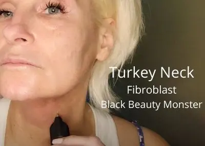 Turkey Neck – Fibroblast with Black Beauty Monster