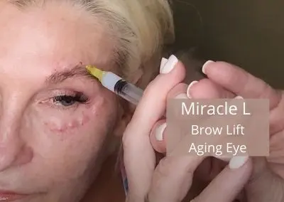 Miracle L – Brow Lift and Aging Eye