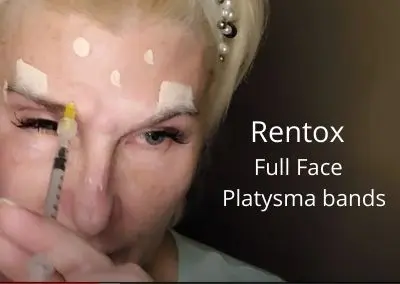 Rentox – Full Face and Platysma bands