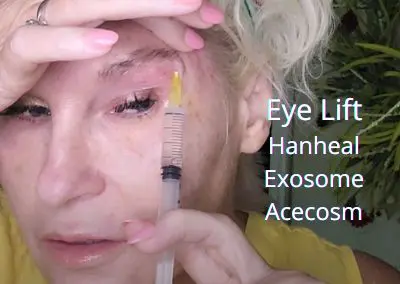 Eye Lift with Hanheal Exosomes from Acecosm