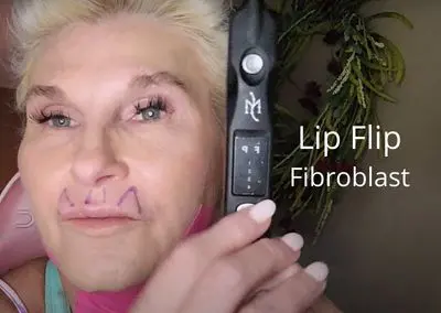 Lip Flip – Fibroblast