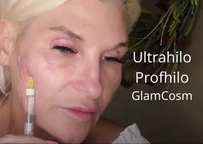 Ultrahilo – Profhilo –  Glamcosm