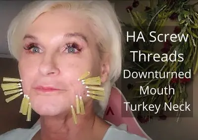 HA Screw Threads – Down Turned Mouth & Turkey Neck