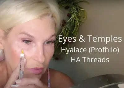 Working on Eyes & Temples – Hyalace (Profhilo) & HA Threads