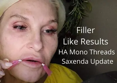 Filler Like Results with HA Mono Threads & Saxenda Update