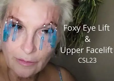 Foxy Eye Lift and Upper Facelift – CSL23