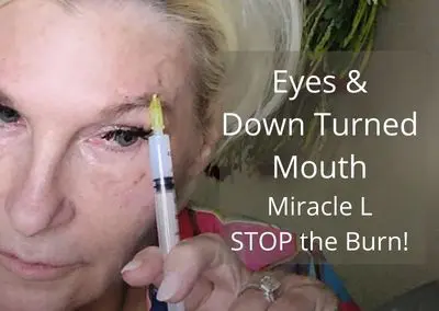 Miracle L – Stop the Burn.  Circle C Pattern & Down Turned Mouth