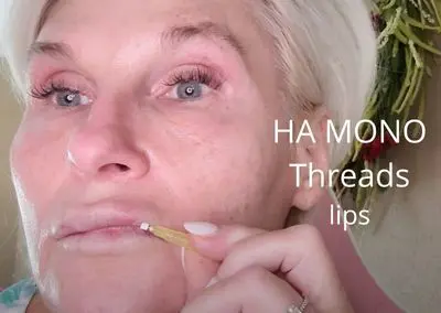 Aging Lips – Full Lips with HA Mono Threads