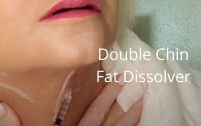 Double Chin | Fat Dissolver – Dr. Lipo V | Aging Neck