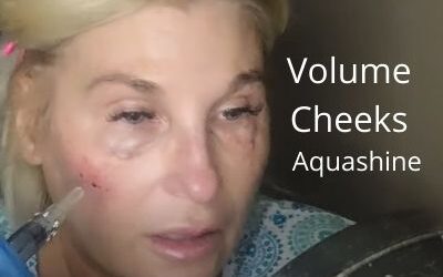 AQUASHINE | Added Volume to Cheeks | GlamDerma