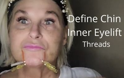 Define Chin | Inner Eyelift | Threads