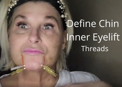 Define Chin | Inner Eyelift | Threads