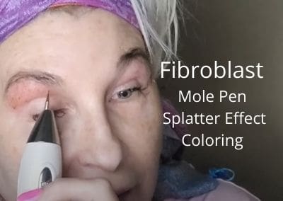 Fibroblast | Mole Pen | Splatter Effect Coloring | Over 50 Eye