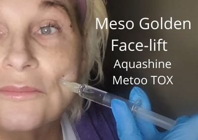 Meso Golden Face-lift | Aquashine | Metoo TOX