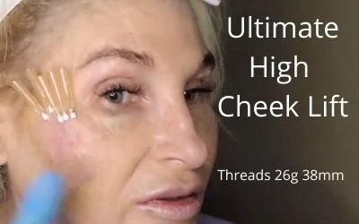 Threads 26g 38mm | Ultimate High Cheek Lift