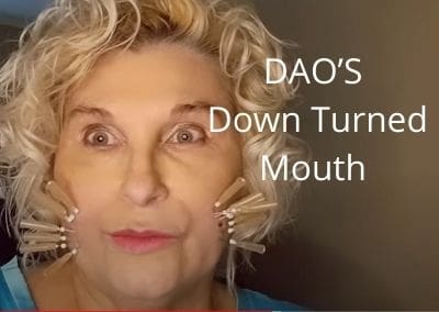 DAO’S | Down Turned Mouth | Thread Lift