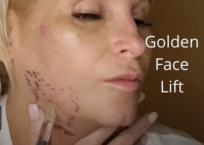 Golden Face  Lift | PDRN Elaxen | Nabota TOX