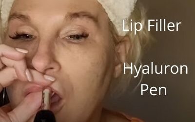 Lip Filler | Tesoro Filler | Hyaluron Pen